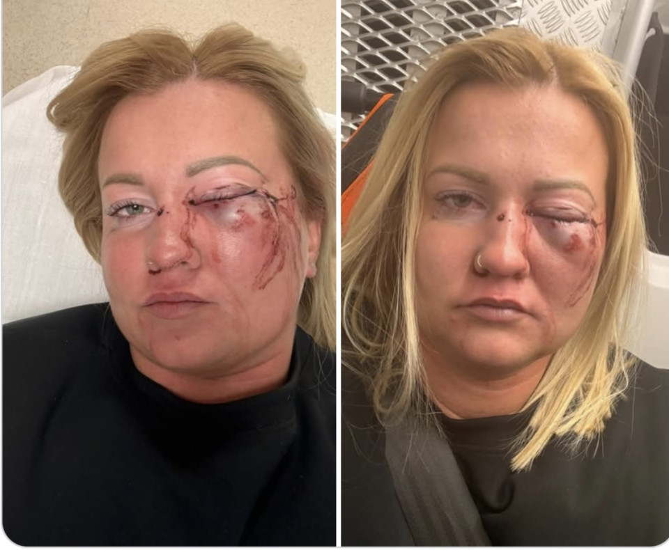 Szarrá vert a fideszes alpolgármester! Itt ülök a mentőben, CT után, miközben a 2. kórházban várjuk hogy fogadjanak és megműtsenek, hogy lássak a bal szememre, miközben az orvosok azt mondták ezt nem tudják garantálni! Nézze el nekem mindenki a helyesírási hibákat, mert nem egyszerű egy szemmel írni! Szentmártonkátán voltam a férjemmel Máté Bordás-sal kolbásztöltő fesztiválon, ahol is némi iszogatás után szóváltásba elegdtem az alpolgálmester úrral! Aki a szeptemberi falunapon volt olyan kedves és felajánlotta, hogy szexuális szolgáltatásokért cserébe nagyon előkelő munkát tud nekem szerezni a hivatalban! Mihelyts kifejeztem nemtetszésemet és bizonyára provokáltam (mert ilyen vagyok és rohadtul elegem van) szét verte a fejemet Bodor András Szentmártonkáta alpolgáltesrere. Ennek több szemtanúja is van, akit most is kihallgat a rendőrség. A férjem természetesen a védelmemre sietett miután én eszméletemet vesztettem és emiatt letartóztatták és őrizetbe vették! Én ezalatt a mentőben várom a sorsomat több, mint 2 órája és az orvosok azt mondták, hogy lehet, hogy soha többé nem fogok látni a bal szememre! Kérdezem én kedves fideszes honfitársaim, ezek után is rájuk szavaztok? Ez nem mesterséges intelligencia. Pokoli fájdalmakat éleket át. Valószínűleg ha a reggelt csendben megvárom meg is vesztegette volna a hallgatásomért. Ezek után is a fideszre szavaztok???Orbán Viktor mit tetszik felelni a történtekre? Ha valaki nem ért együtt, el kell venni a szeme világát? Ez a fideszes szokás? Én vállalom az arcom, engem nem érdekel, ez nem szégyen! Ez a valóság ma Magyarországon!